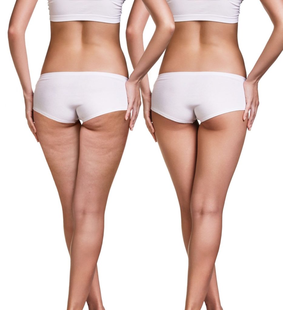celulitis