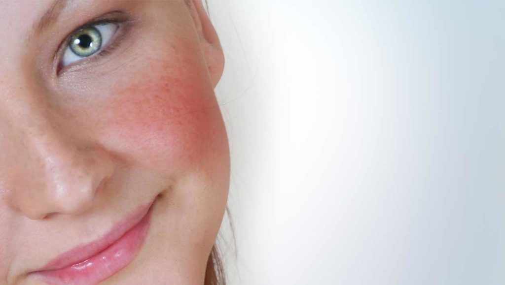 rosacea grid