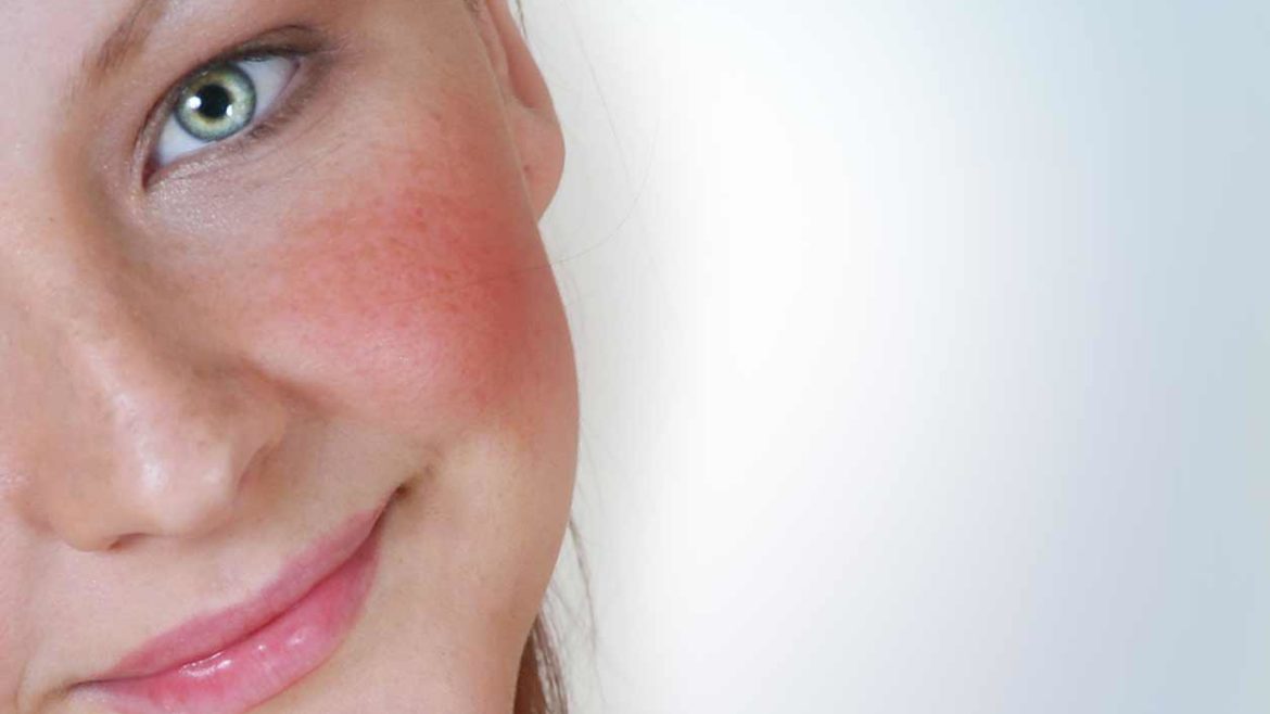 rosacea grid