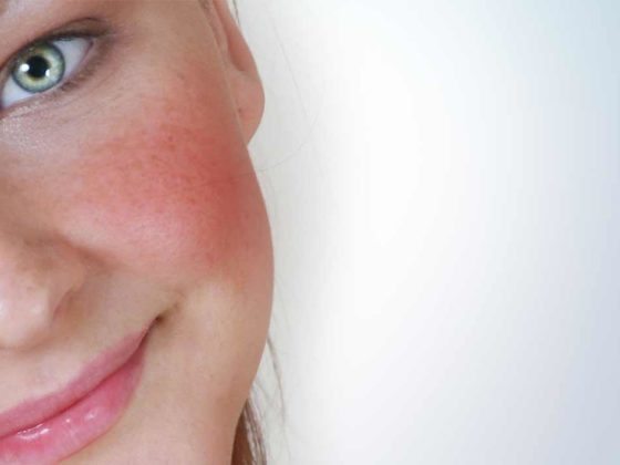 rosacea grid