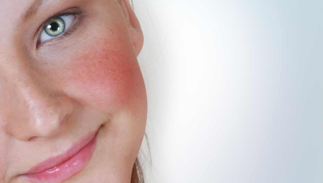 rosacea grid