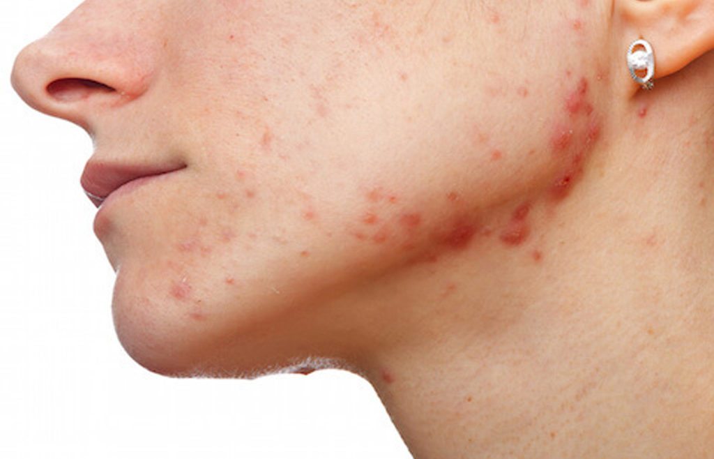 rosacea piel