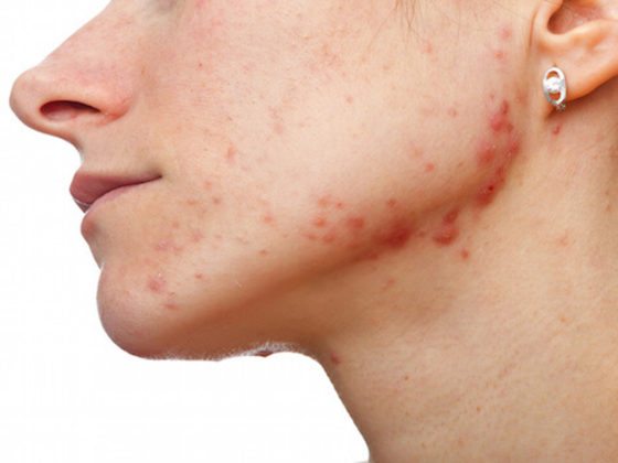 rosacea piel