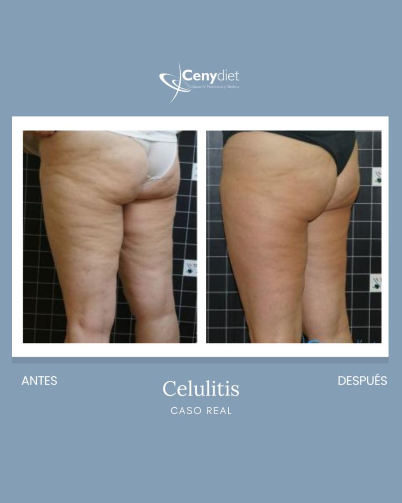 Cenydiet tratamiento celulitis en Jaén