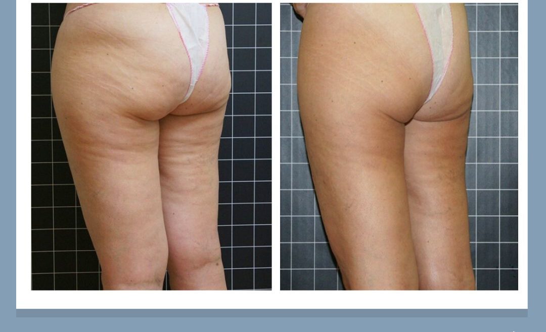 Cenydiet tratamiento celulitis piernas gluteos 2 en Jaén