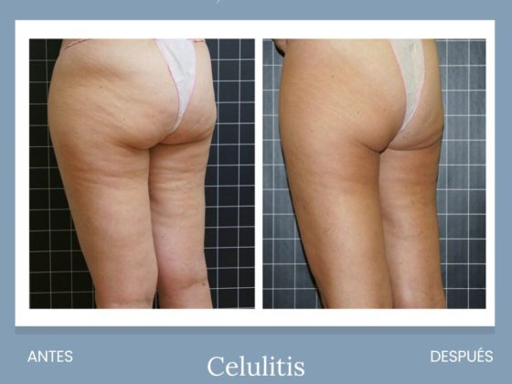 Cenydiet tratamiento celulitis piernas gluteos 2 en Jaén