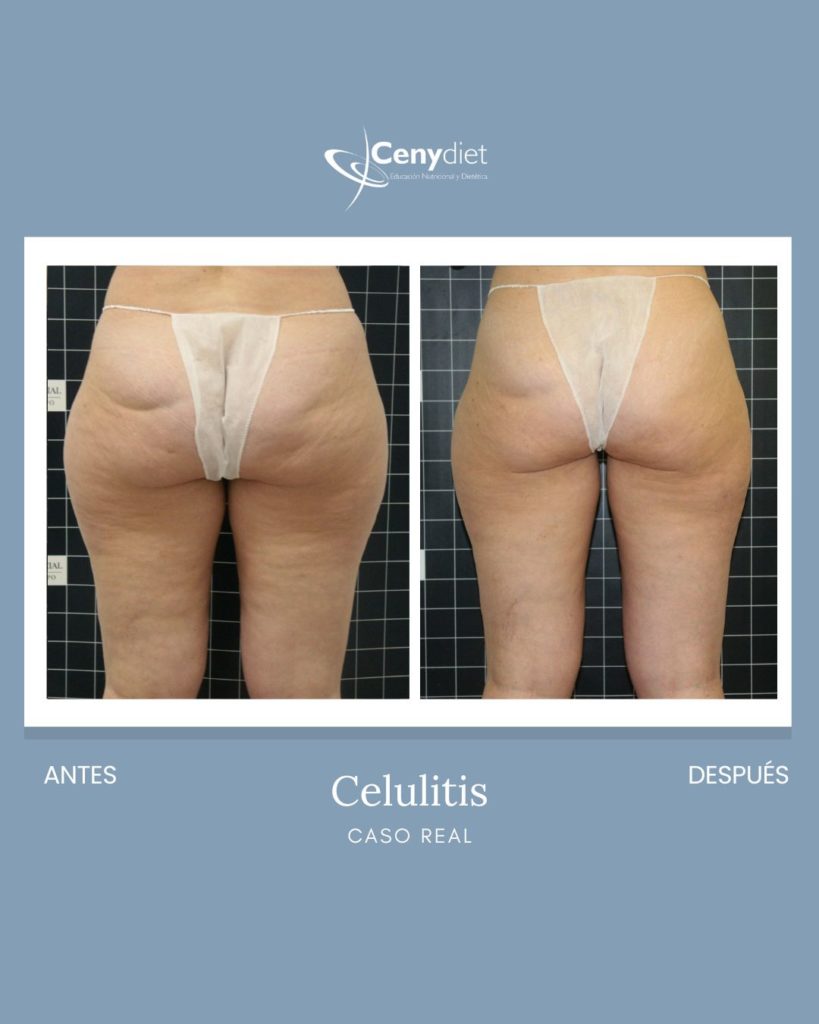 Cenydiet tratamiento celulitis piernas gluteos en Jaén