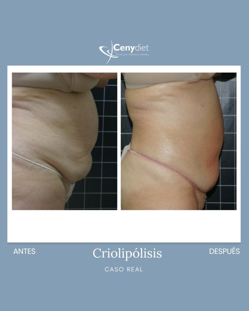 Criolipólisis Jaén Linares