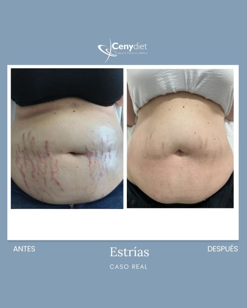 Tratamiento de estrías Jaén, LInares
