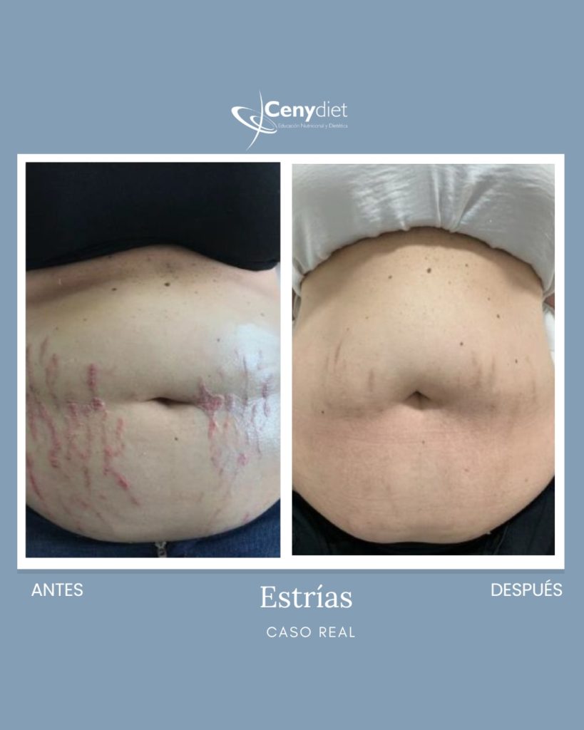 Tratamiento de estrías Jaén, LInares
