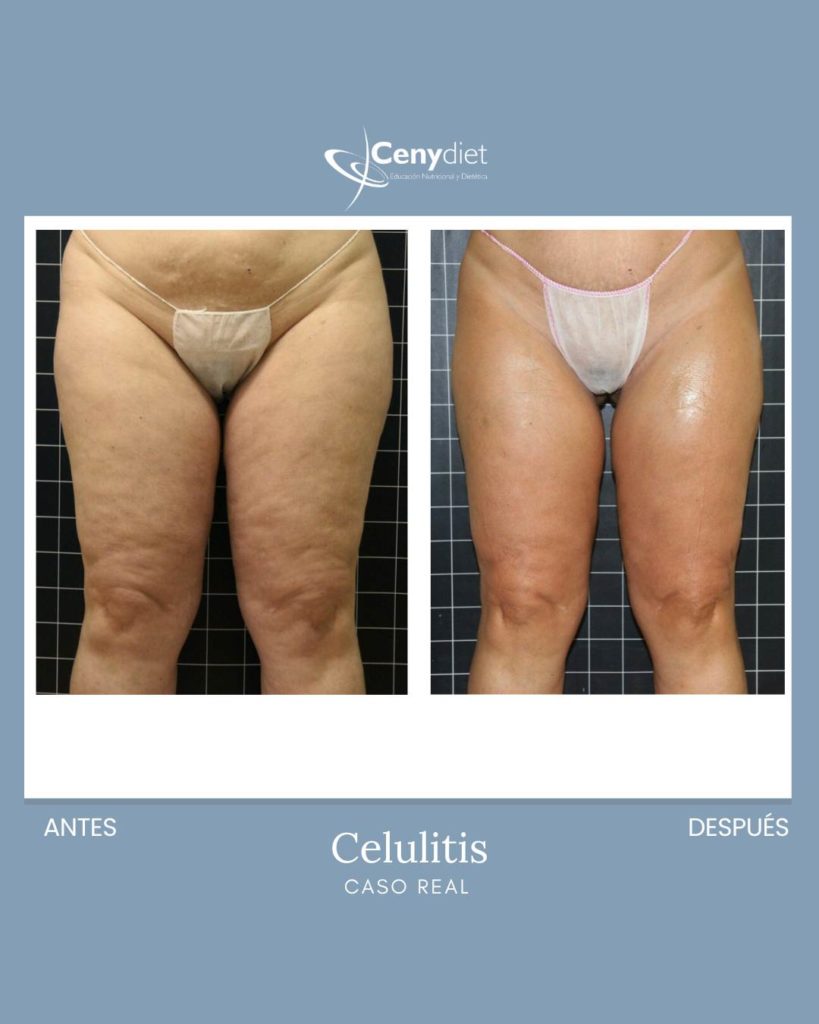 Tratamiento de celulitis Jaén Linares