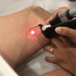 eliminacion varices con laser