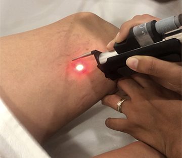 eliminacion varices con laser