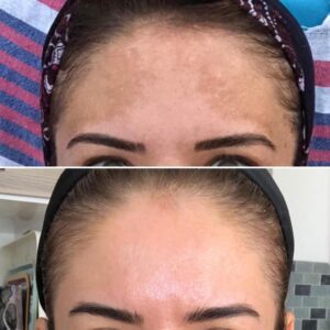 Eliminar manchas resistentes melasma en Jaén