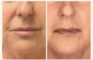 rejuvenecimiento facial mediante regeneración celular