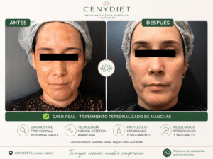 Cómo tratar el melasma con diagnóstico personalizado en CENYDIET Linares